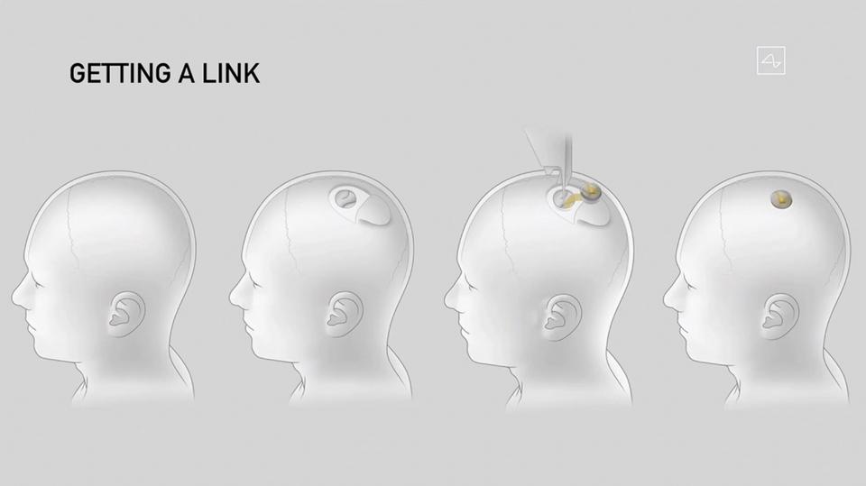 رسم يبيّن الخطوات المختلفة لزراعة جهاز Neuralink في رأس الإنسان
